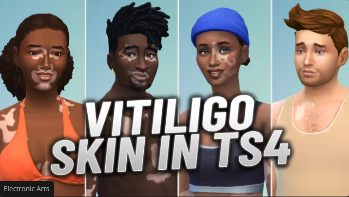 The Sims 4 Adds Vitiligo Skin Feature